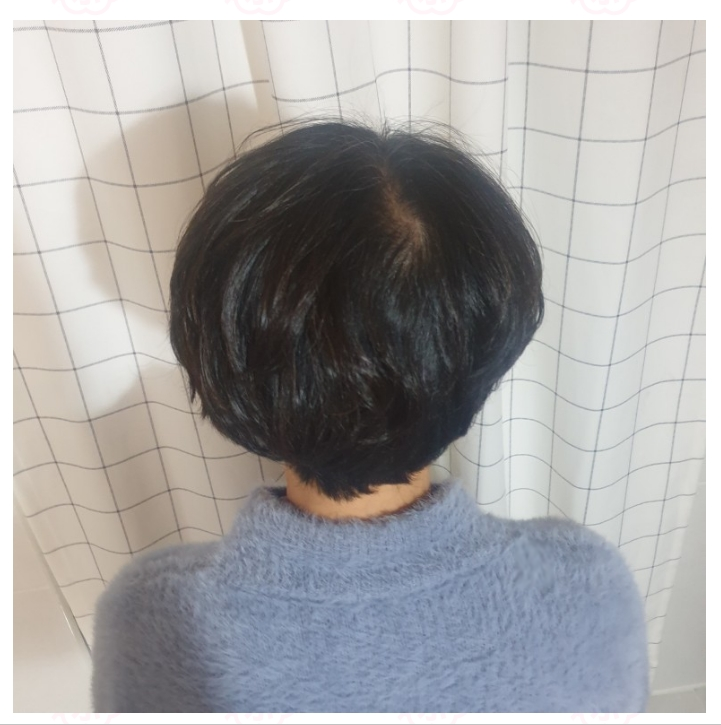  뒤통수 탈모, 뒷가르마 탈모, 여성에게 특히 도드라는 이유 & 뒷가르마 영구적 없애기 사례