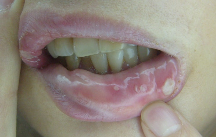 구내염(stomatitis), 구강염, 구순포진, 구개염, 설염, 치은염