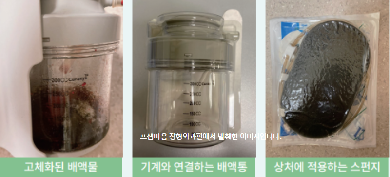 curavac (CURA-VAC, 큐라백) 음압 치료기 무엇을 확인해야 할까? : 네이버 블로그