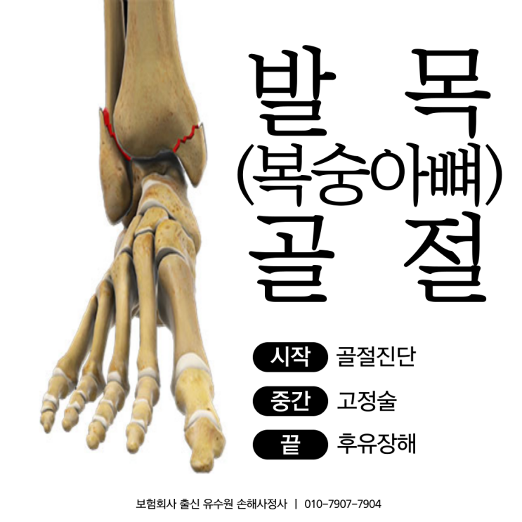  복숭아뼈골절 후유장해 보험금 쉽게 포기하실 건가요?