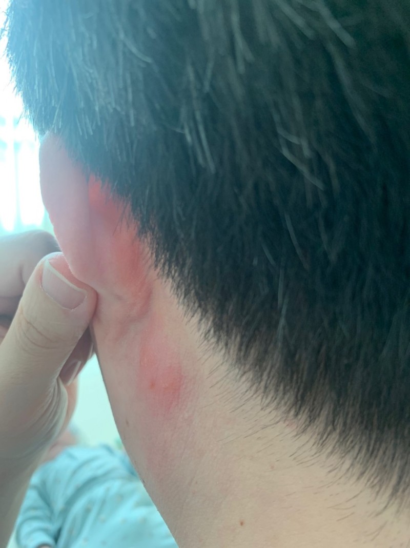 1) 귀 뒤 멍울로 시작해 몸에 붉은점으로 번진 대상포진 초기증상, 치료후기 - 역곡 한피부과 : 네이버 블로그