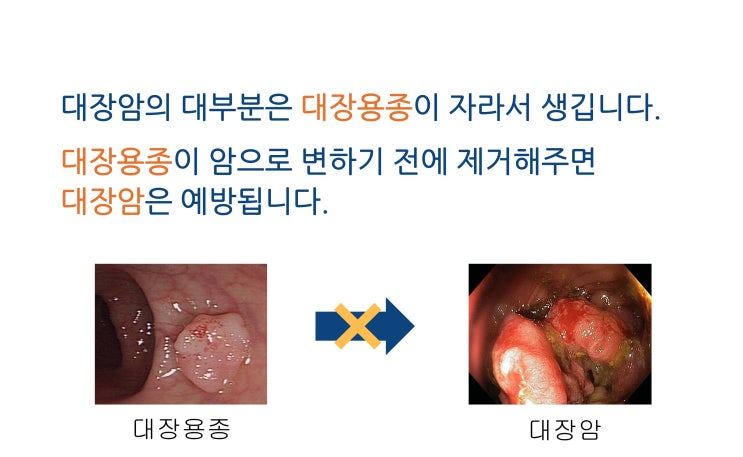  국가 대장암 검진 : 대변잠혈검사에 대하여(대장내시경 잘하는 강북내일내과)