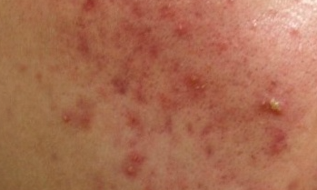  엑소좀(Exosome) 스킨 부스터의 항염·항균 효과