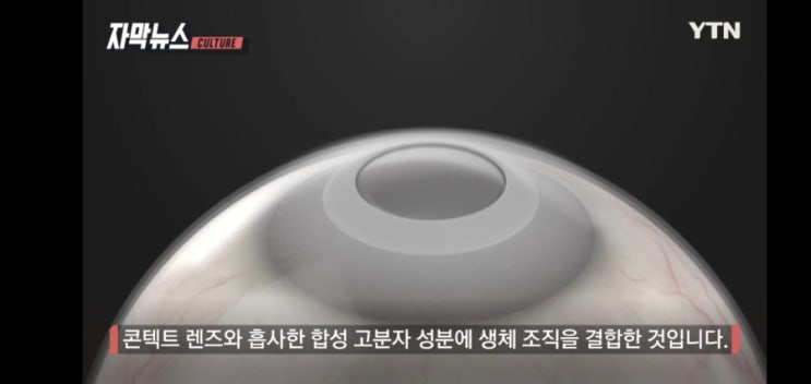  세계 최초 '인공 각막' 우리나라서 발명, 곧 상용화 기대