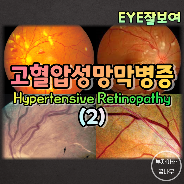 [EYE잘보여] 고혈압이 눈에도 생긴다?, 고혈압성 망막병증(Hypertensive Retinopathy) (2) - 망막소견(안저소견)에 따른 분류, 치료, 예후