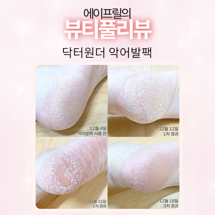 닥터원더 악어발팩 사용 후 14일간의 변화 후기 닥터원더 악어발팩 사용 후 14일간의 변화 후기