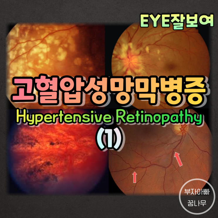  [EYE잘보여] 고혈압이 눈에도 생긴다?, 고혈압성 망막병증(Hypertensive Retinopathy) (1) - 원인, 병태생리, 망막소견, 안저소견