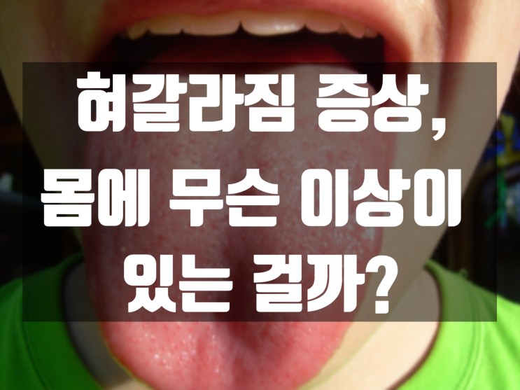 혀갈라짐 증상, 몸에 무슨 문제가 있는 걸까요?