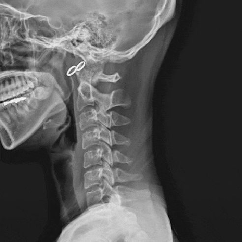  물리치료사가 알려주는 일자목, 거북목, 일자목+거북목 의 차이점