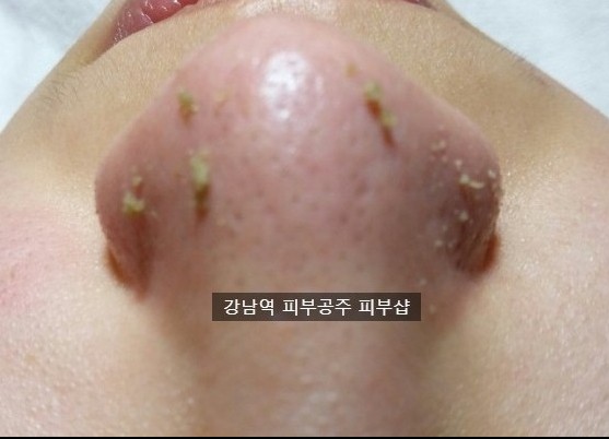  혐오주의 얼굴과 코 블랙헤드 묵은 피지제거 모공관리 까지 한번에