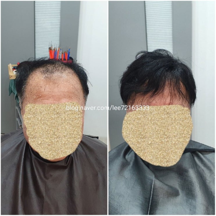  해봅시다! 보톡스증모술  가발덕후와함께해요 