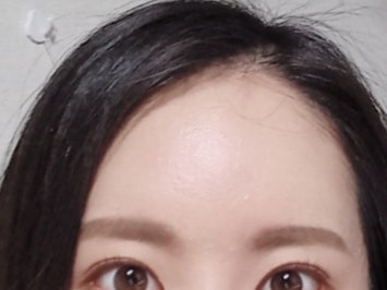 이마필러 3개월 후기! 이마필러 1cc 3cc? (+ 붓기, 가격, 부작용,전후 차이) : 네이버 블로그 이마필러 3개월 후기! 이마필러 1Cc 3Cc? (+ 붓기, 가격, 부작용,전후 차이) : 네이버 블로그