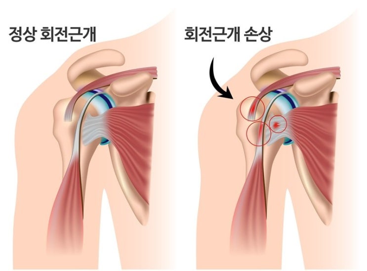 팔꿈치,어깨 통증, 이러면 막을 수 있습니다 - 적절한 풀업 수행 자세