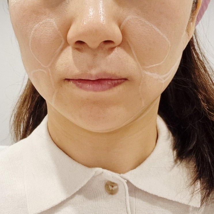  동탄 텐쎄라 리프팅으로 얼굴라인 변화