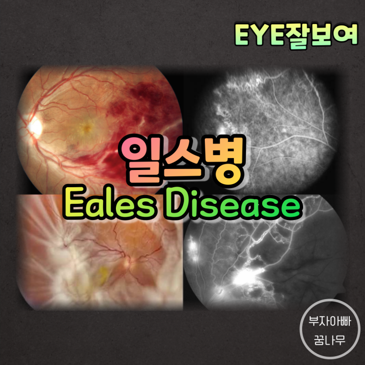 [EYE잘보여] 일스병(Eales Disease) - 역학, 원인, 임상양상, 증상, 치료, 예후