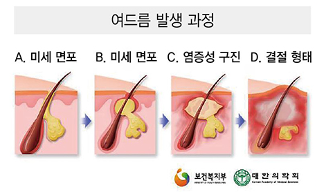  여드름 홈 케어를 위한, 여드름 연고의 모든 것!