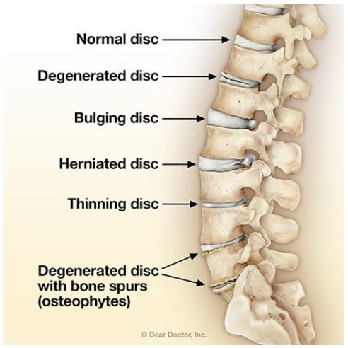  [이수역 필라테스] 40~50대때 꼭 운동해야되는 이유는? - 퇴행성 척추증(Degenerative Spondylosis) 관련 편