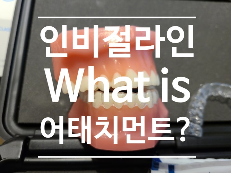 인비절라인 어태치먼트의 기능과 모양, 그리고 필요한 부가 장치 인비절라인 어태치먼트의 기능과 모양, 그리고 필요한 부가 장치