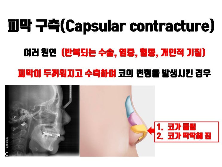  구축코 재수술을 위해서 비중격연장술이나 꼬리쪽회전이식술보다 중요한 과정이 있어요!!!
