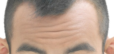  이마필러와 이마 주름필러는 다른 시술입니다~