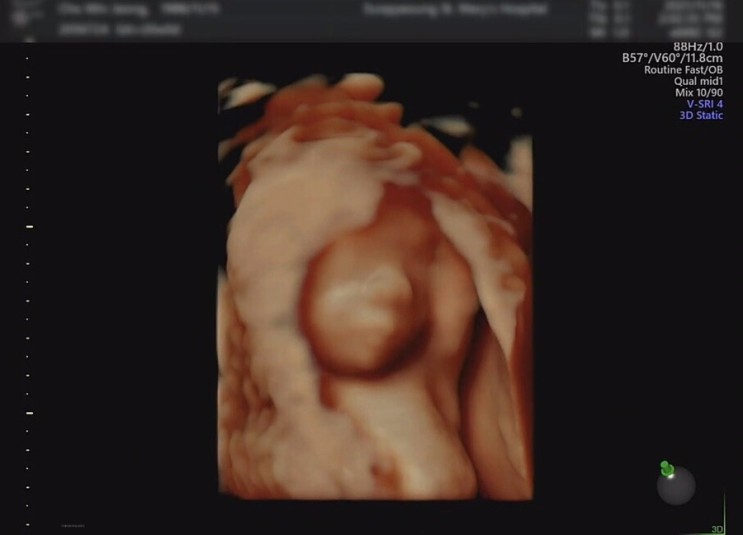 [임신 20주] 정밀 초음파 검사 : 은평성모병원 산부인과