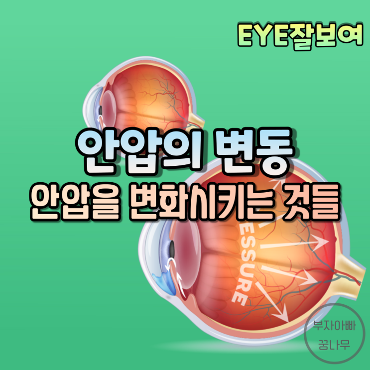  [EYE잘보여] 안압(IntraOcular Pressure; IOP)에 영향을 주는 것들 - 정상안압, 안압 증가 요인, 안압 감소 요인