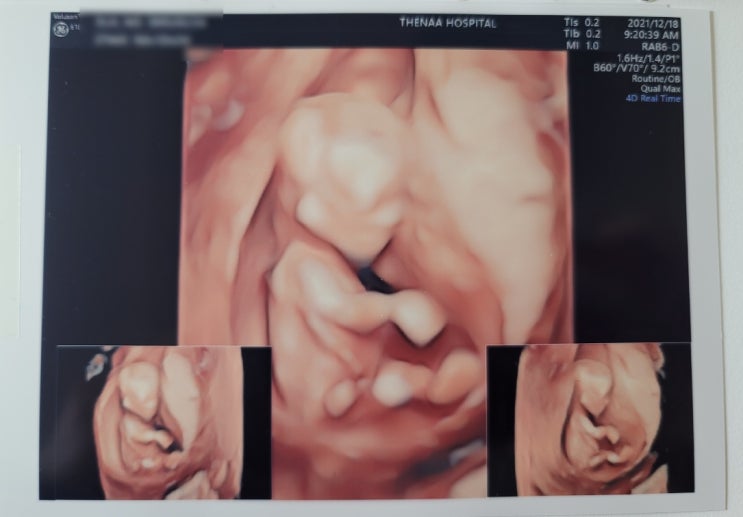  [진짜귀여워]12주차_1차기형아검사(목투명대,코뼈확인,피검사,취약X-증후군검사)