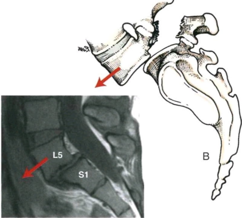 Iliopsoas (장요근, 엉덩허리근) : Iliacus + Psoas Major (장골근 + 대요근) : 네이버 블로그