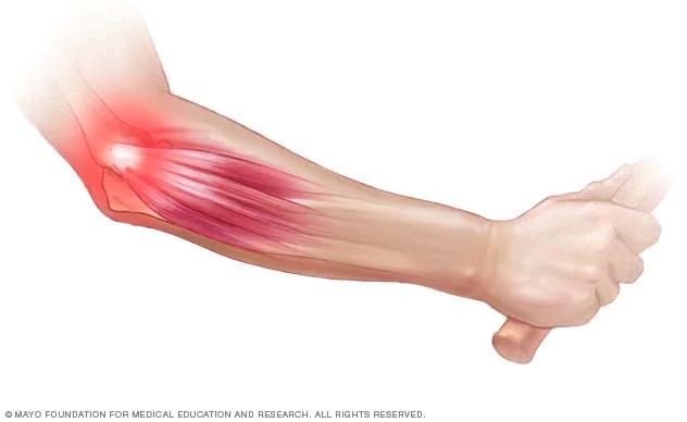 팔꿈치 바깥쪽 통증 - 외측상과염?