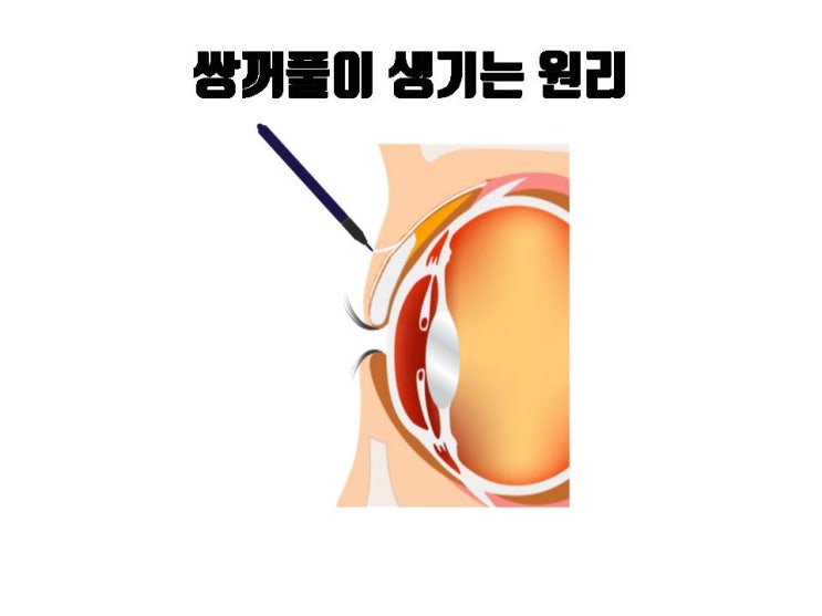  이전 쌍꺼풀 수술로 라인은 마음에 드는데 안검하수가 있다면 눈매교정만 다시 하면 돼요!!!