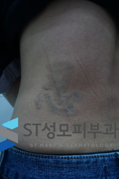  문신제거 피코레이저 (part 2) 문신제거 시 염두에 둘  것들 - 삼성중앙역 피부과 전문의 닥터림