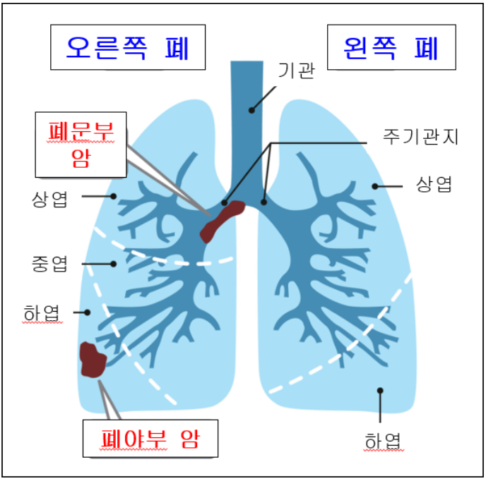  비소세포폐암,소세포폐암 치료와 부작용,재발과 전이 및 생존율 보기