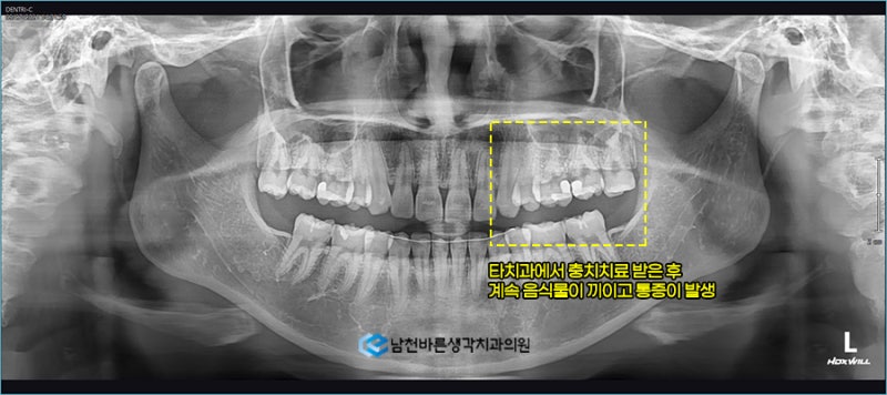 상감금을 씹을 때마다 아파요 – 남천치과병원, 루징치과병원