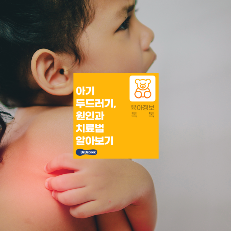  두드러기가 생겼는데 어떻게 할까요? 돌아기 두드러기 치료방법