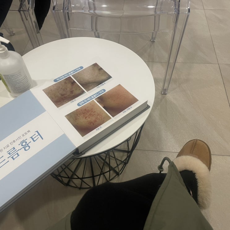  노원여드름흉터 남자친구 여드름치료 프로젝트 시작!