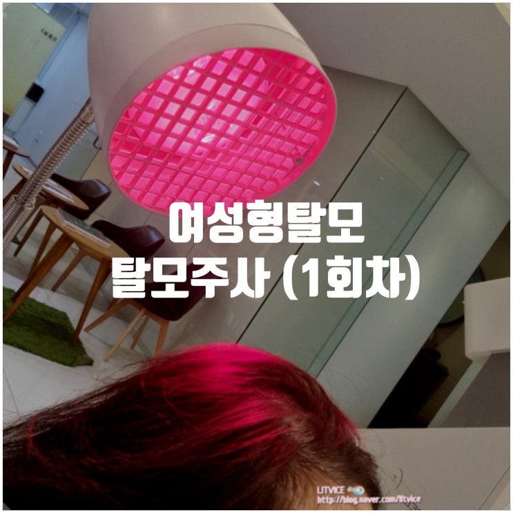  서울모발이식이 궁금하다! 탈모주사로 여성형탈모 탈출기(1회차)