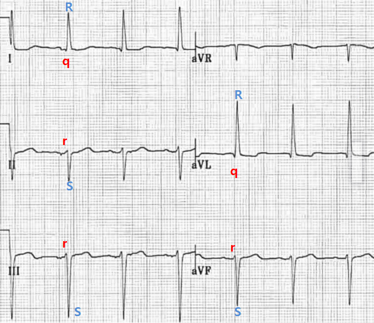심전도 공부 - Left anterior fascicular block (LAFB) : 네이버 블로그