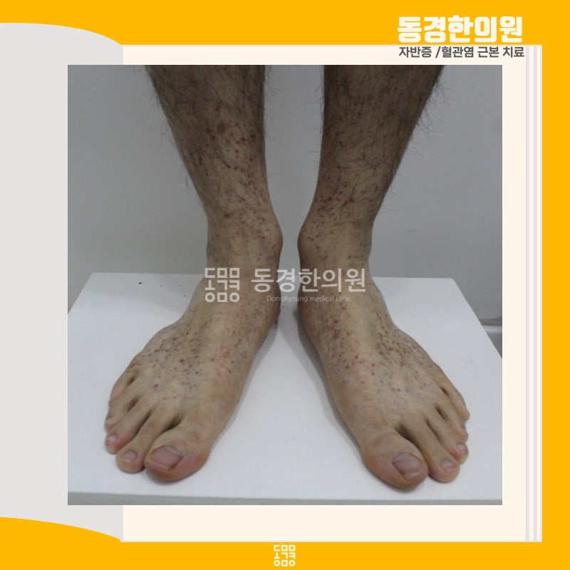 자반병의 원인은 사람마다 다릅니다. 내 자반병의 원인은 무엇입니까? 자반병의 원인은 사람마다 다릅니다. 내 자반병의 원인은 무엇입니까?