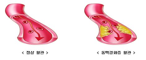  [달서구주간보호센터] 동맥경화_송현동/죽전/성서/화원/화원읍/대곡동/월성동/상인동/본리동/용산동/두류동/본동/성당동/이곡동/대명동/진천동/도원동/장기동/감삼동/대구/주간보호센터