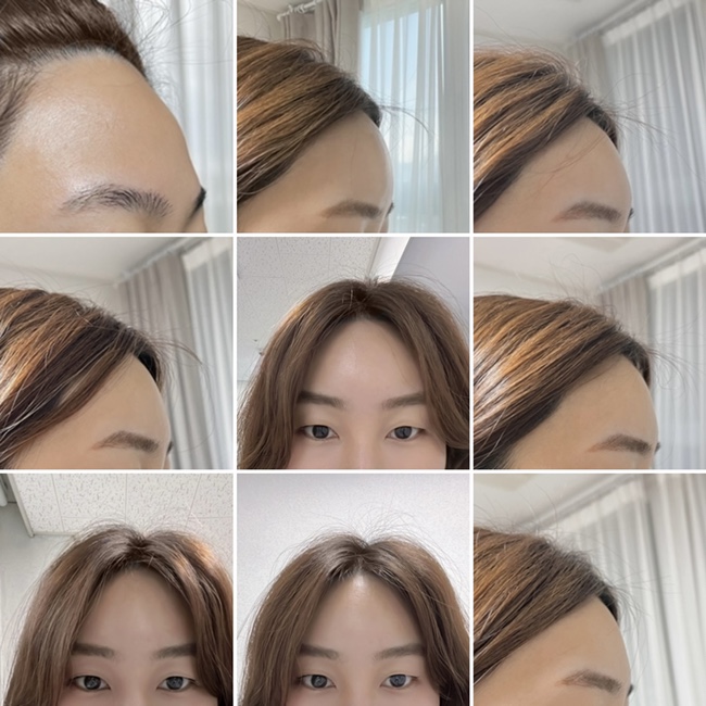 이마 필러 후회 만족감 붓기 솔직 후기 이마 필러 후회 만족감 붓기 솔직 후기