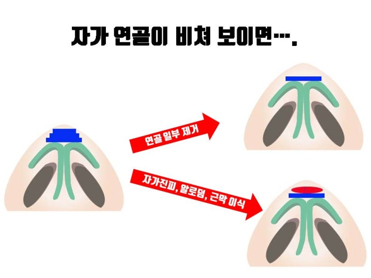  코끝 수술 후 코끝에 연골이 비쳐 보일 경우 어떻게 해야 하나요?