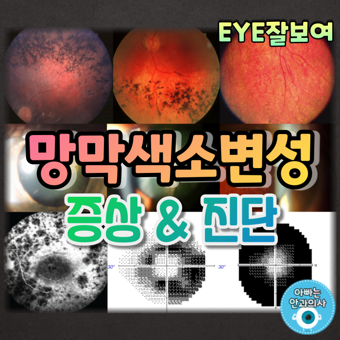 [EYE잘보여] 망막색소변성, 망막색소변성증 (1) - 증상, 소견, 진단 및 검사
