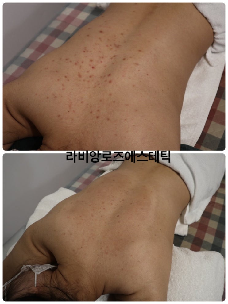  등 여드름색소 고민 왜 하세요? 알라딘필링으로 해결하세요!