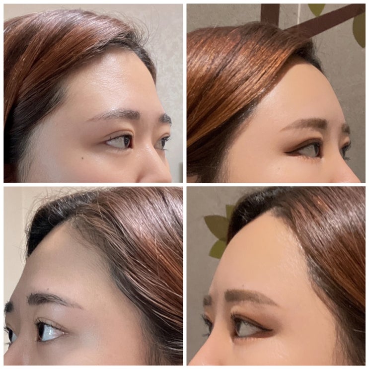  선릉역 피부과 보톡스 이마필러 잘하는곳 골드제이의원 첫 필러 도전기