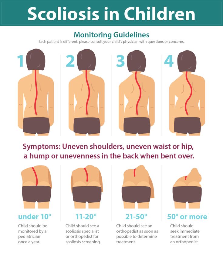 척추측만증 원인 및 증상 치료 방법