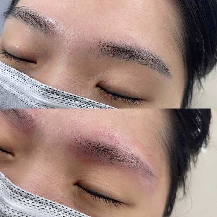 눈썹문신 잔흔제거 데미지 없이, 깔끔하게 임상이 많은곳에서 제대로 하세요 눈썹문신 잔흔제거 데미지 없이, 깔끔하게 임상이 많은곳에서 제대로 하세요