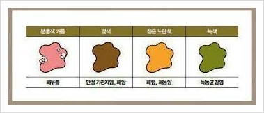  목에 가래가 생김(황색가래, 백색가래, 각혈) 폐암, 천식환자