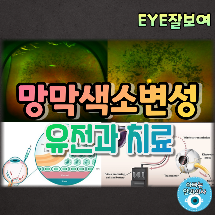  [EYE잘보여] 망막색소변성, 망막색소변성증 (2) - 유전, 종류(분류), 치료(약물, 수술), 합병증
