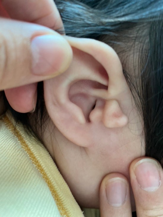 내 아이에게 스킨텍이라니!?!_신생아스킨택, 선천성부이주, 아기귀젖, skin tag, 연성섬유종 알아보기(제거수술 병원 추천 포함) 내 아이에게 스킨텍이라니!?!_신생아스킨택, 선천성부이주, 아기귀젖, skin tag, 연성섬유종 알아보기(제거수술 병원 추천 포함)
