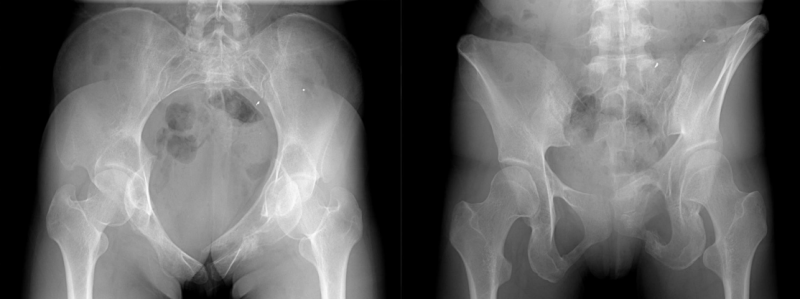 Pelvis & Hip : 네이버 블로그